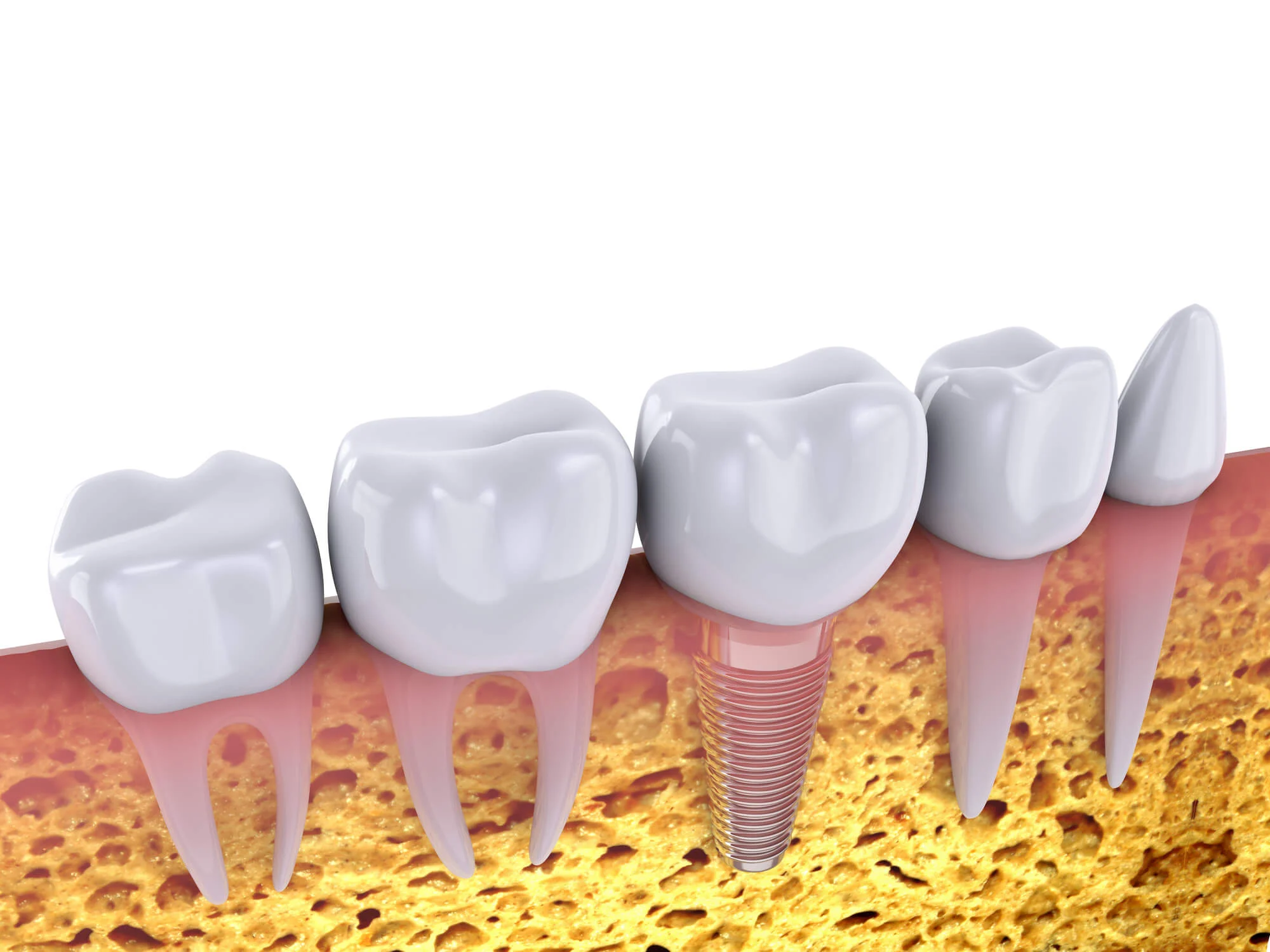 illustration of dental implants in montgomery .jpg
