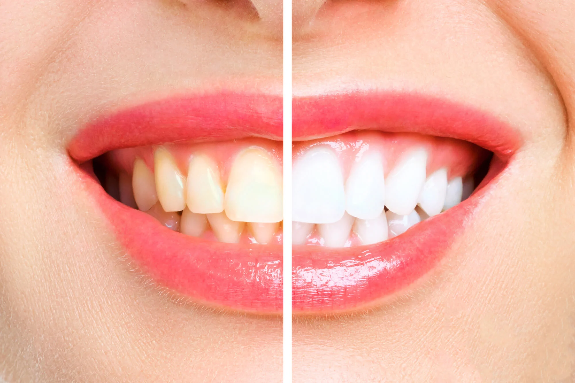 before and after teeth whitening in montgomery al.jpg