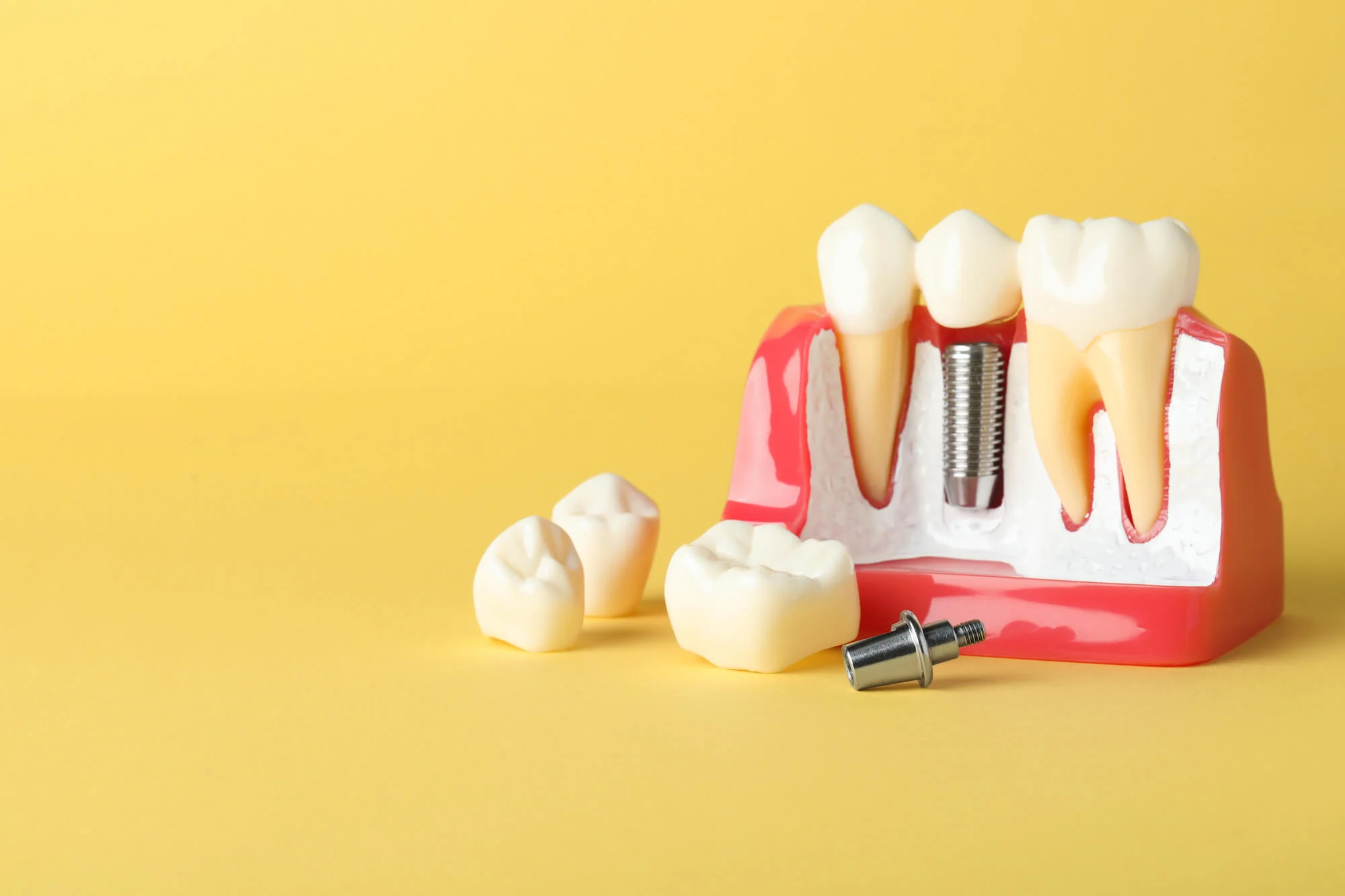 good dental implants model