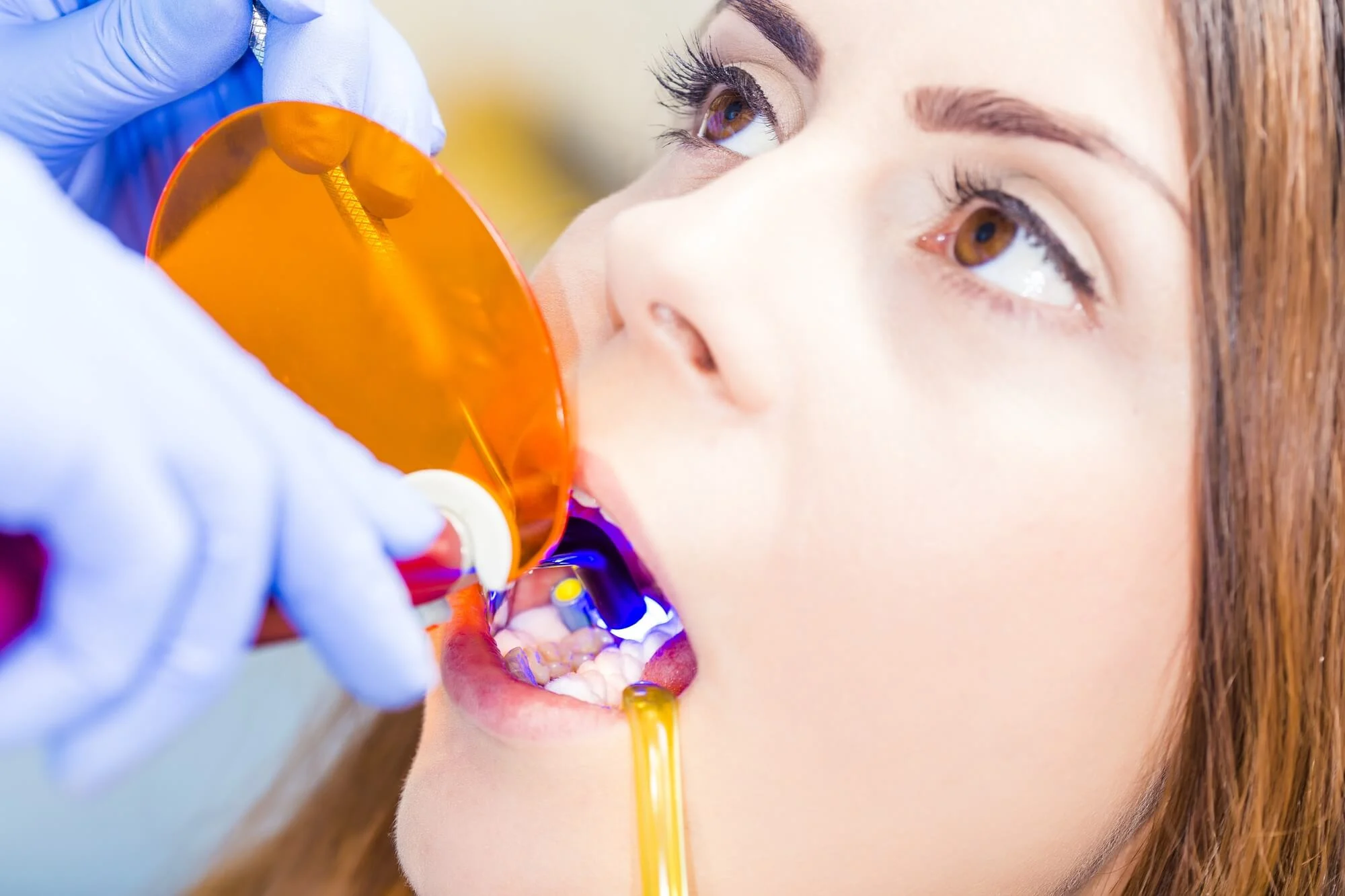 dentist applying dental bonding in montgomery al