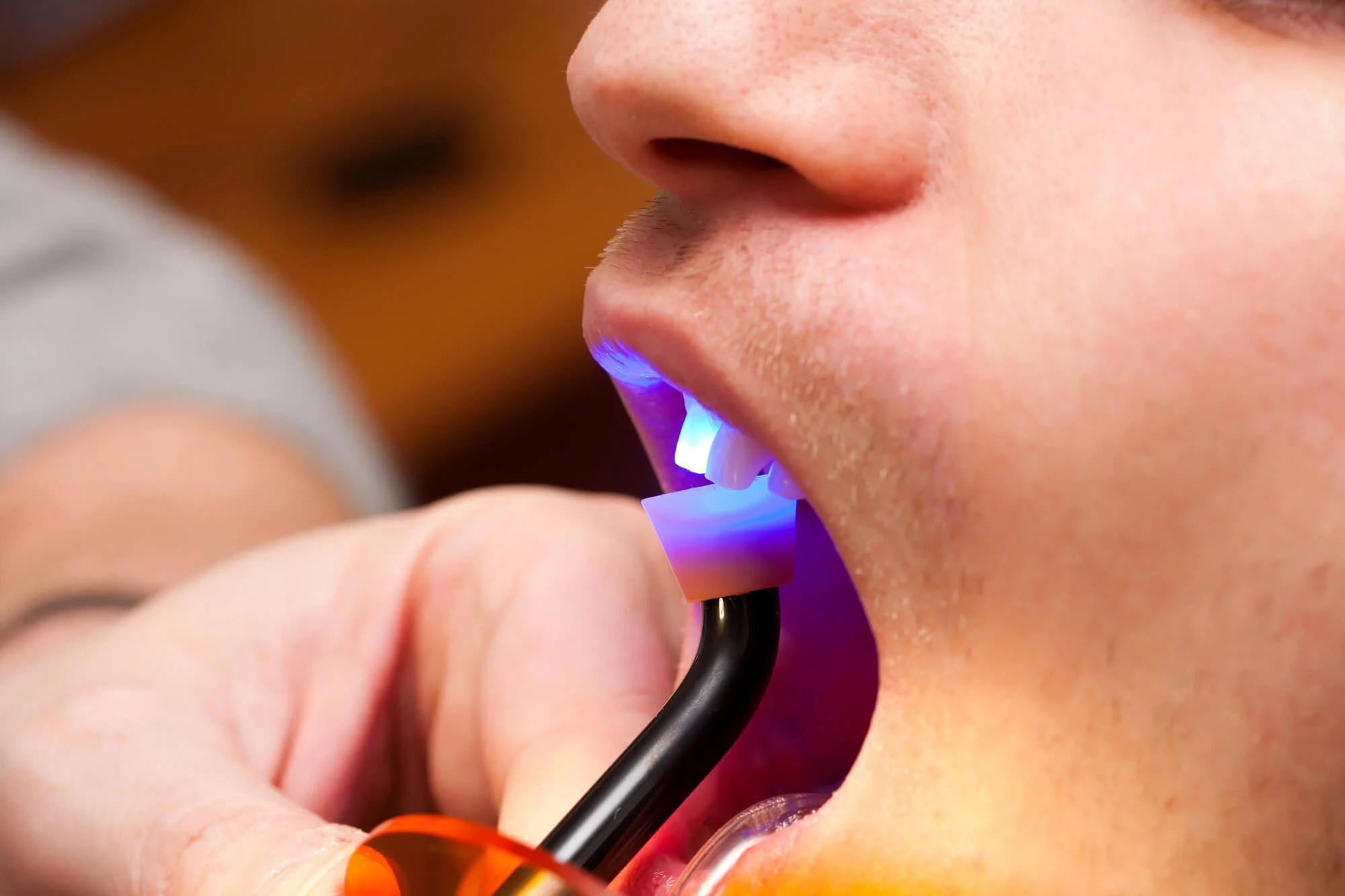 on going dental bonding in montgomery al