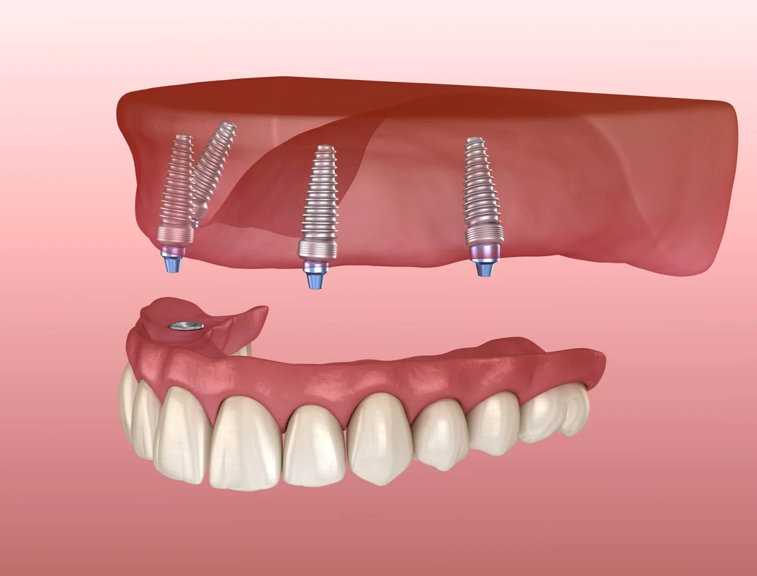 All-on-4® Dental Implants: A Comprehensive Guide to a Full Smile Makeover