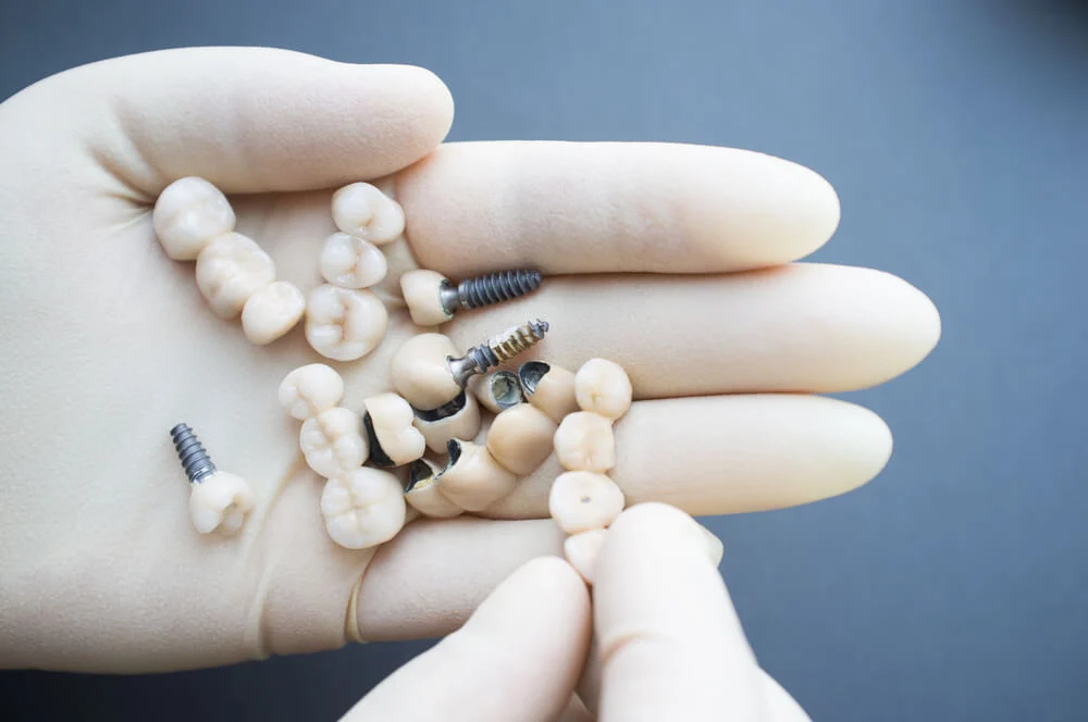 Dental Health Checklist: Preparing for Full Dental Implants