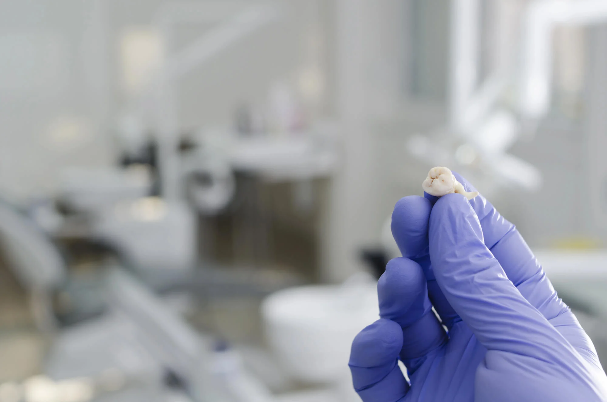 tooth extraction cost Alabama