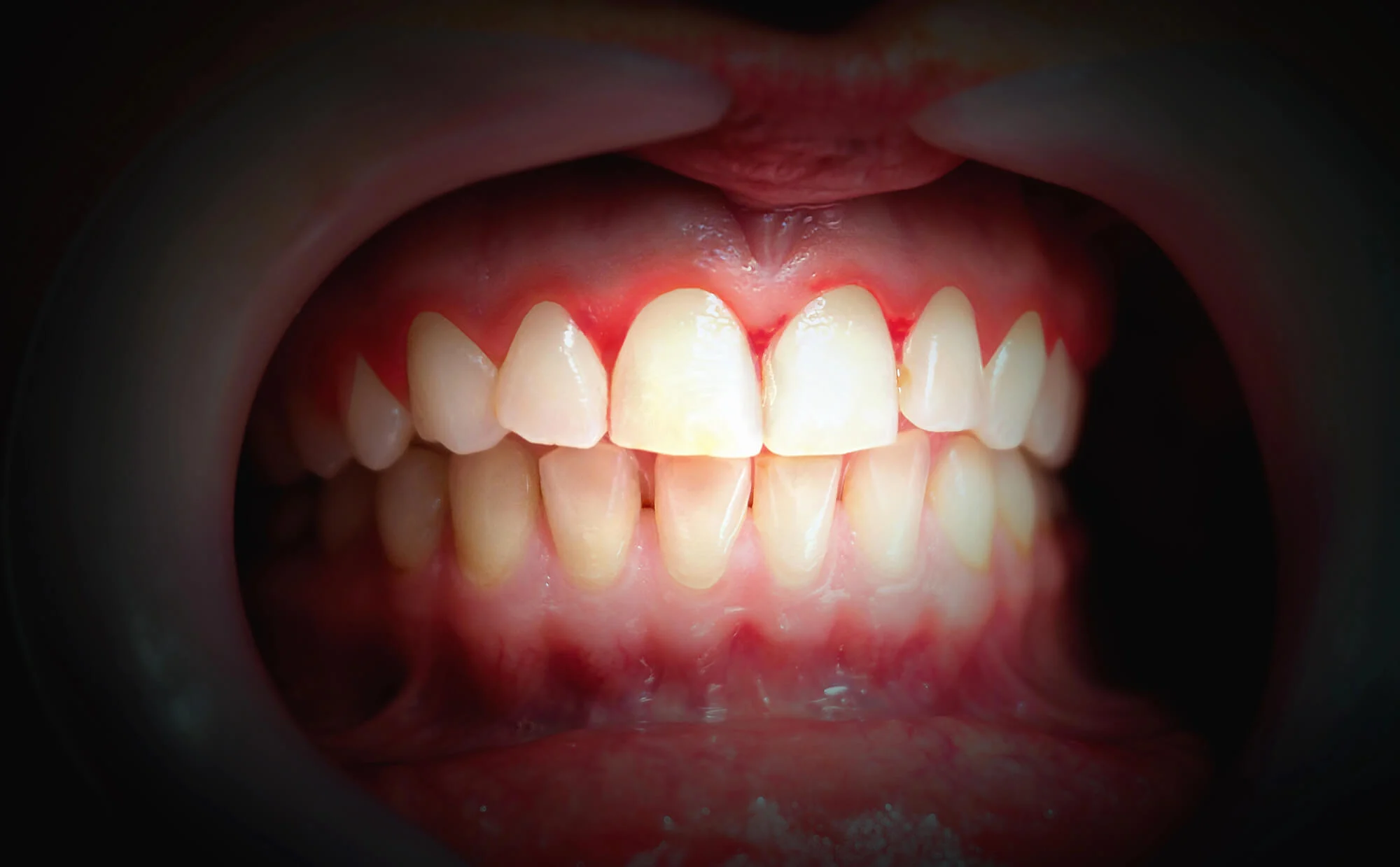 bleeding gums that need dental implants in montgomery al