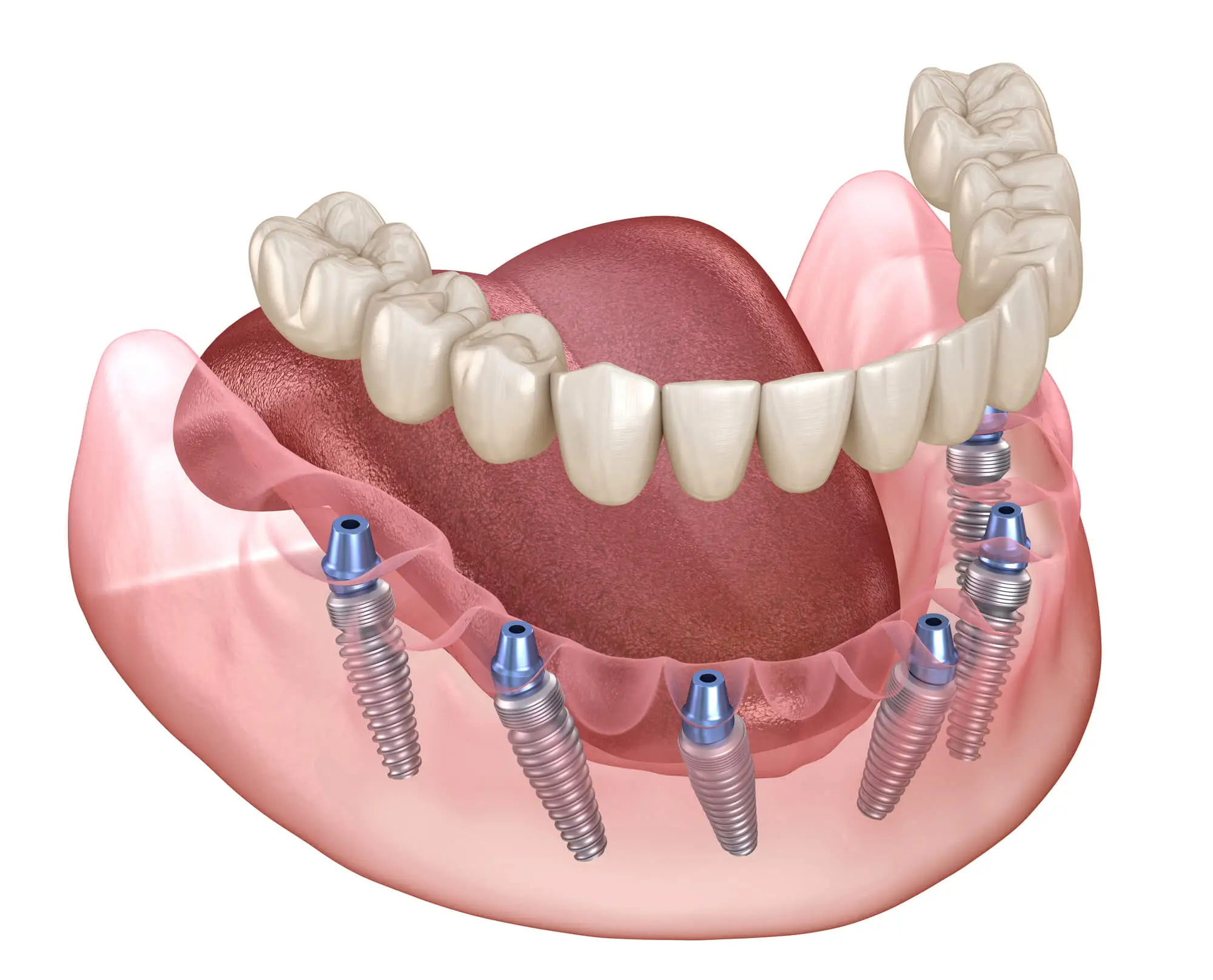 Illustration of All-On-Four® Dental Implants Near Me