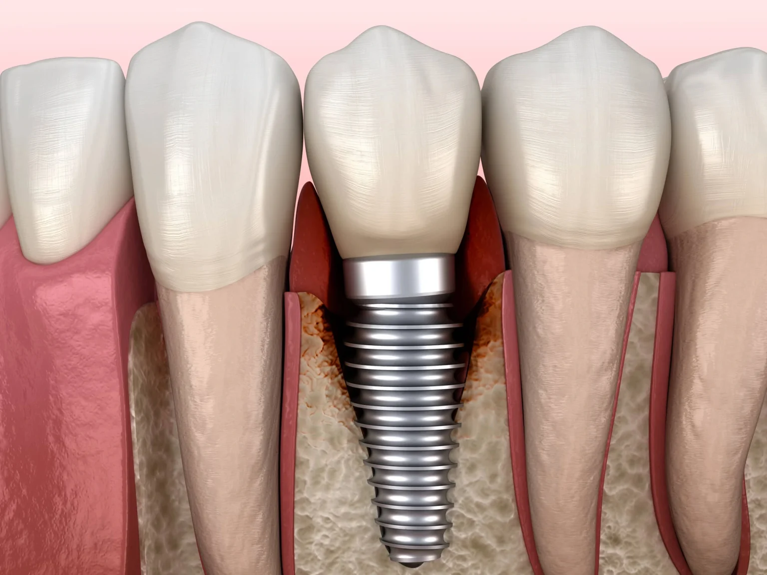 What Is Peri-Implantitis—And What Can You Do to Prevent It?
