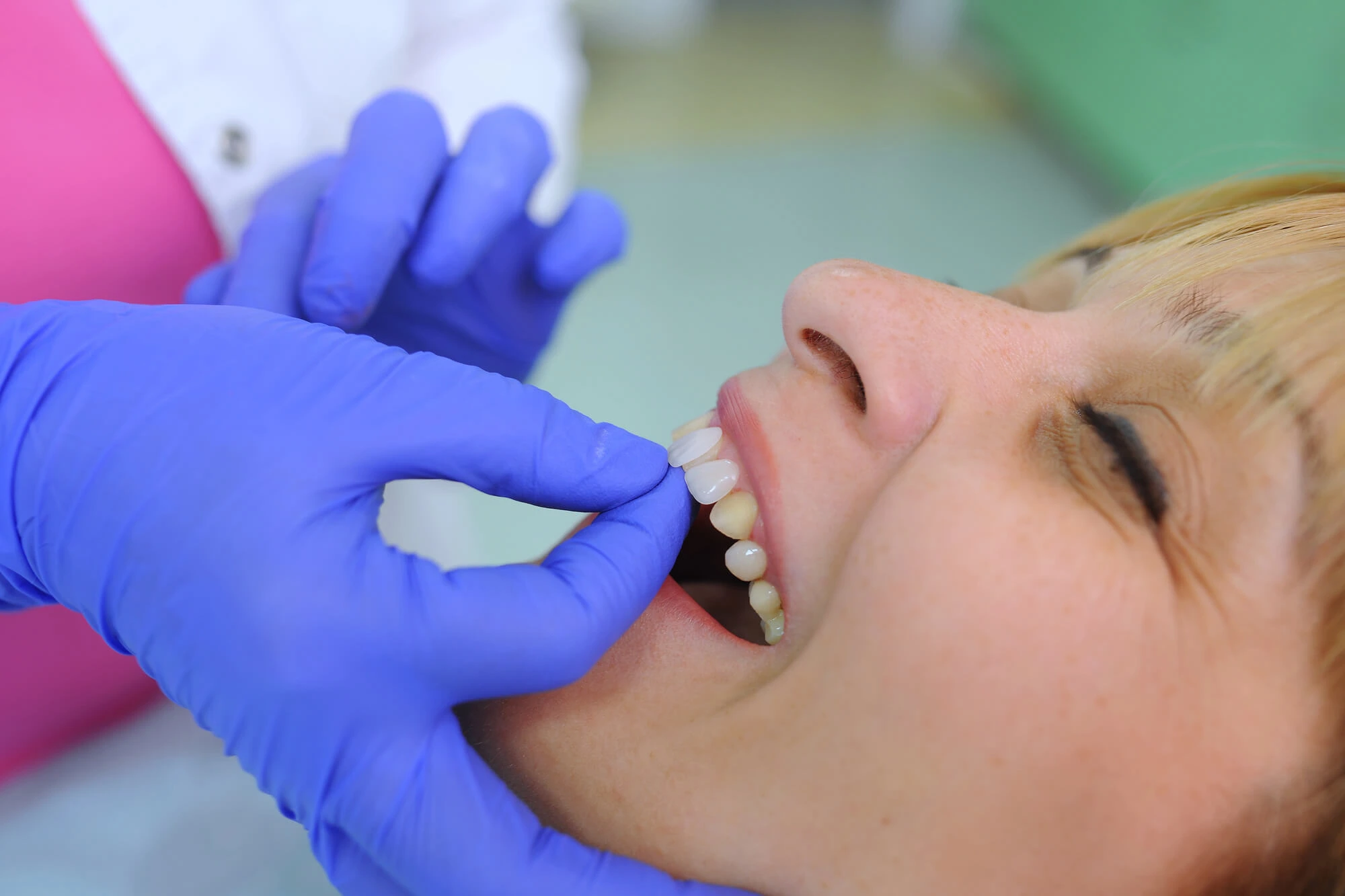 Montgomery Dentist Placing Veneers