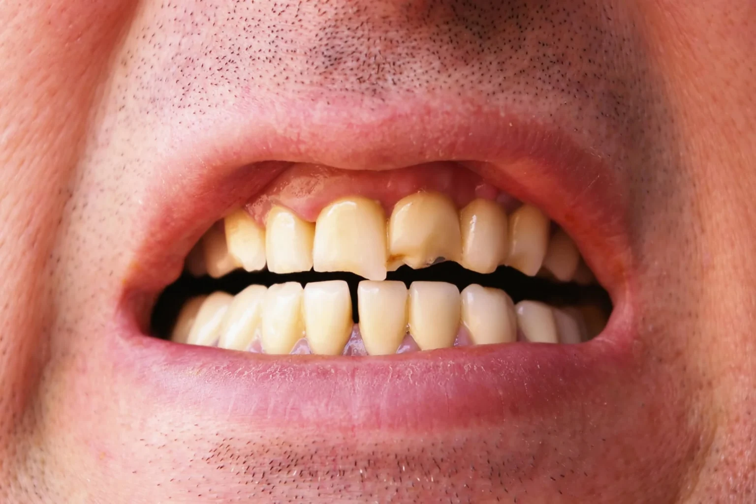 Can You Repair a Cracked Tooth with Dental Bonding?