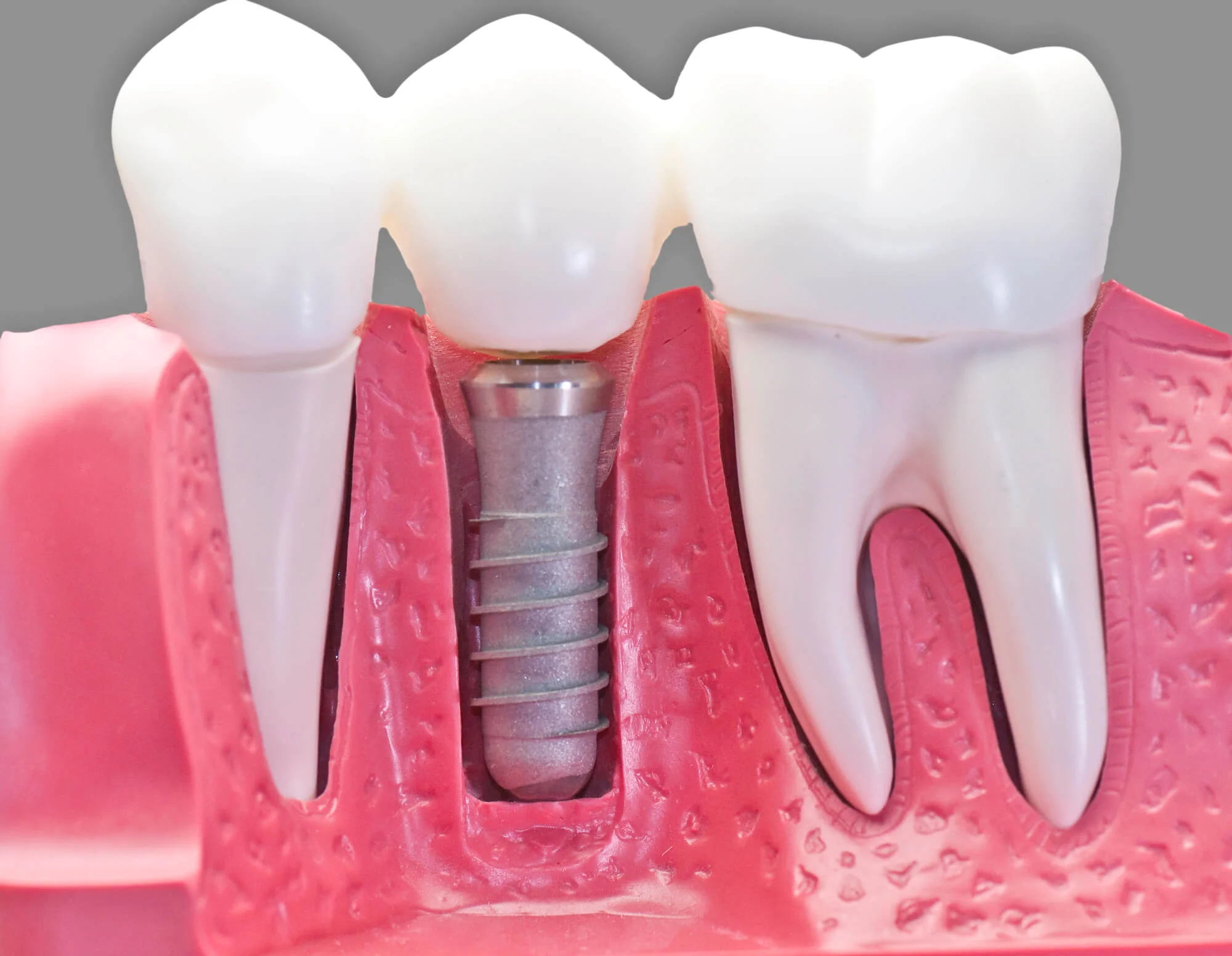 Close-up model showing dental implant placement, good dental implants near you