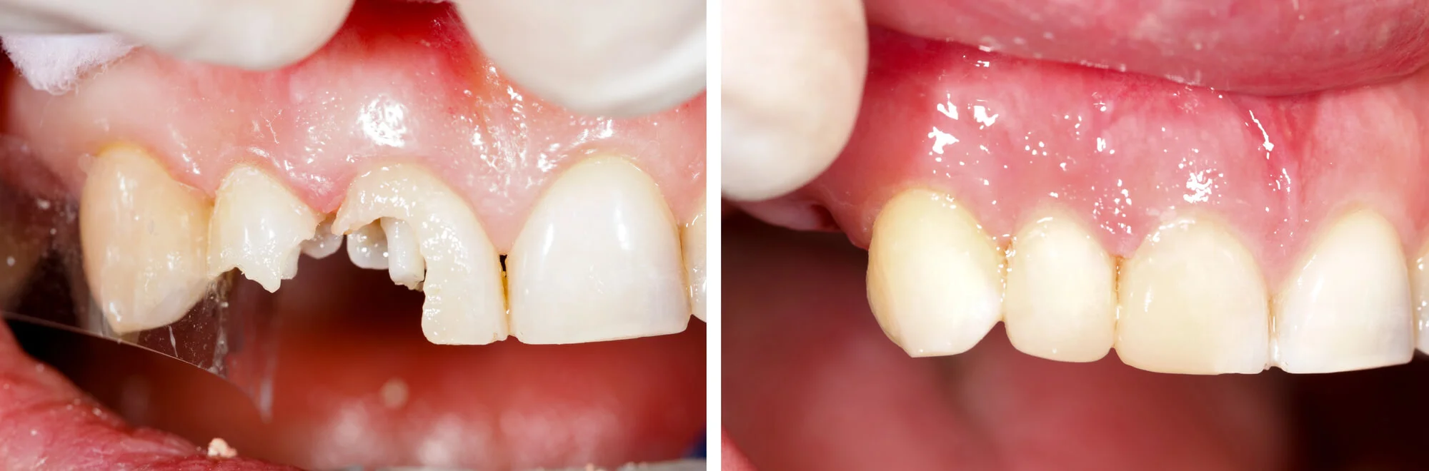 Before and after: broken front tooth restored