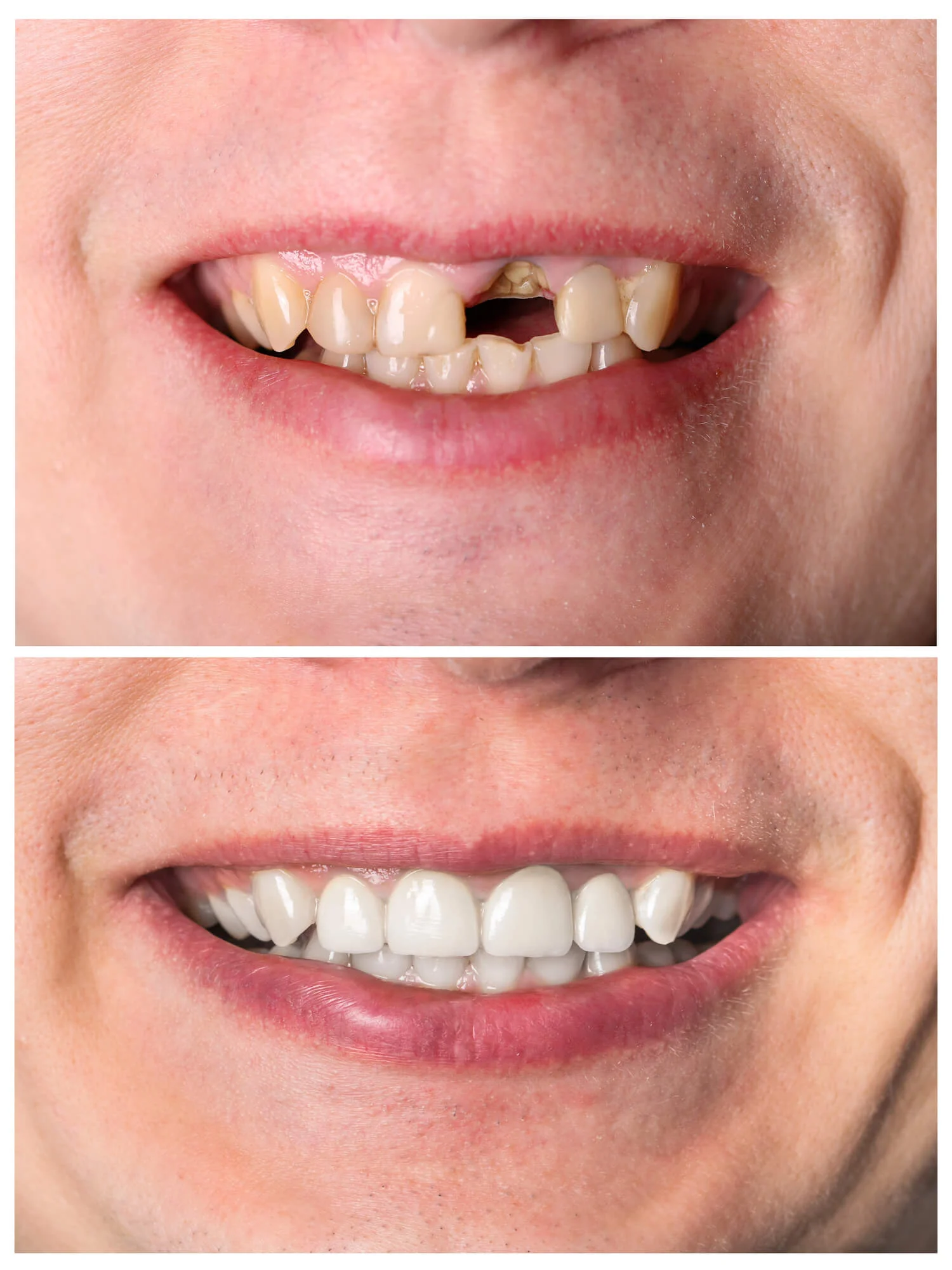 Before and after: gap from a missing front tooth filled