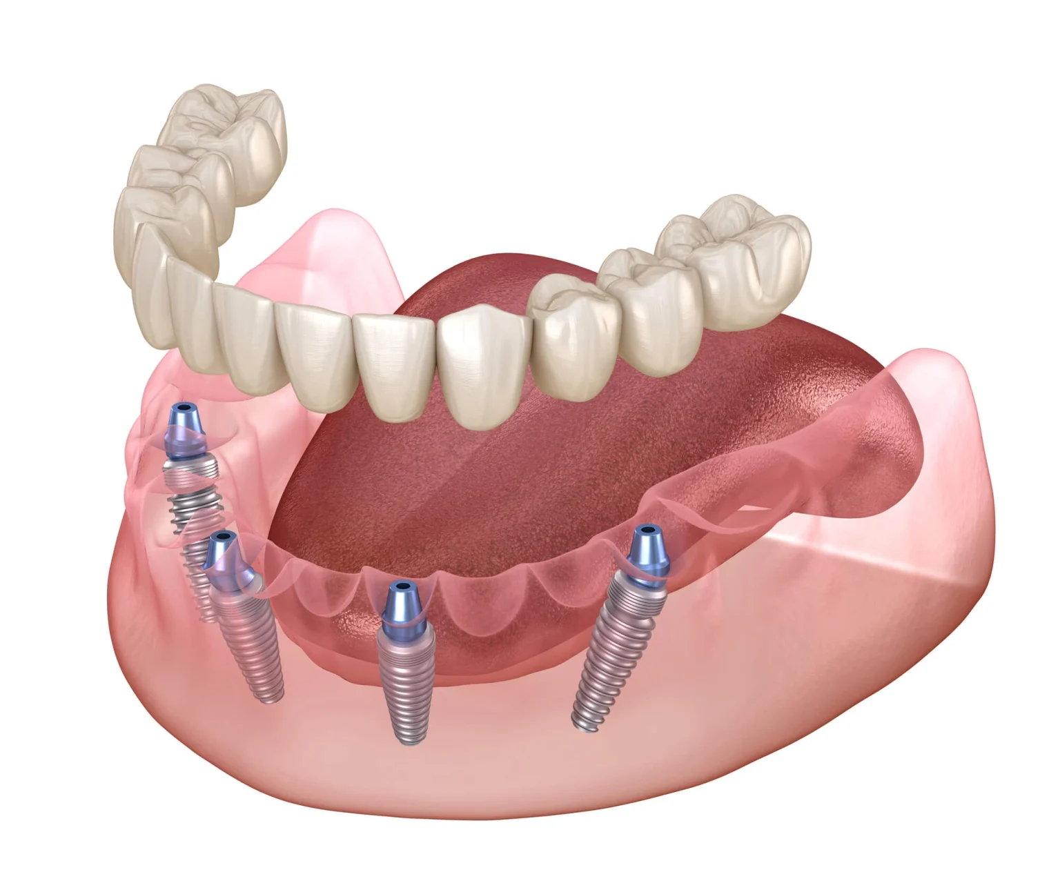 Restoring Your Smile with Full-Arch Dental Implants