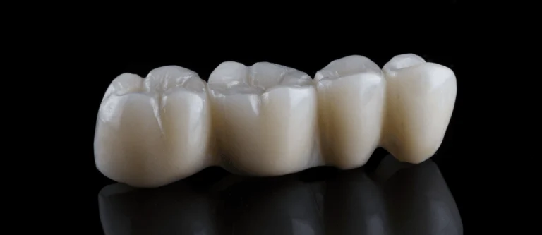dental bridge for missing molar
