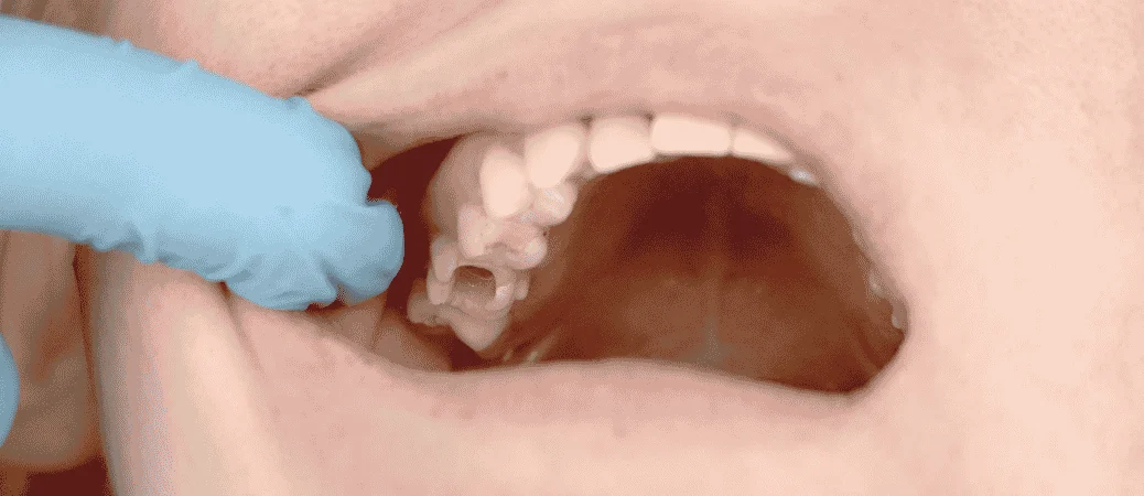 Filling Fell Out While Eating: What to Do Before Your Appointment
